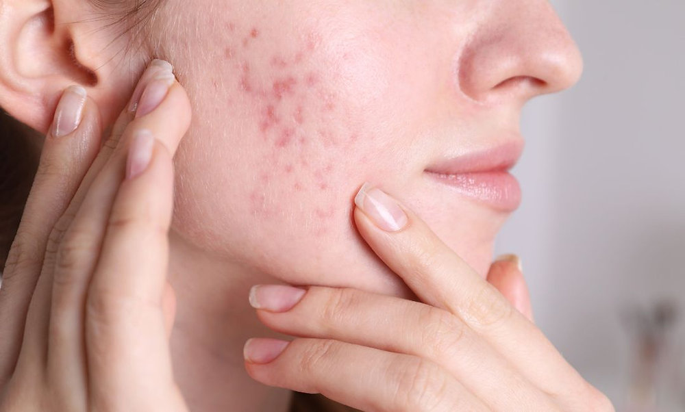 Pigmented acne scars on cheek treated
